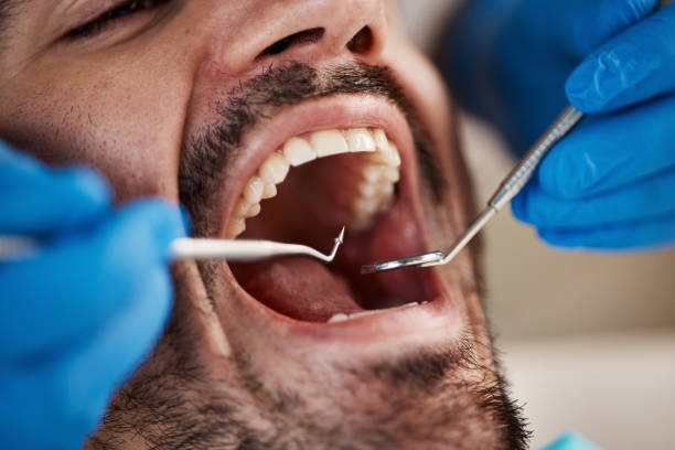 Best Wisdom Tooth Removal  in Ardmore, OK
